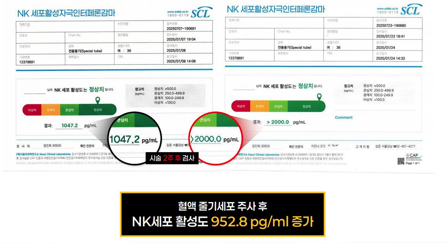 36세 여성 환자 NK 세포 활성도 시술 전후 비교 자료