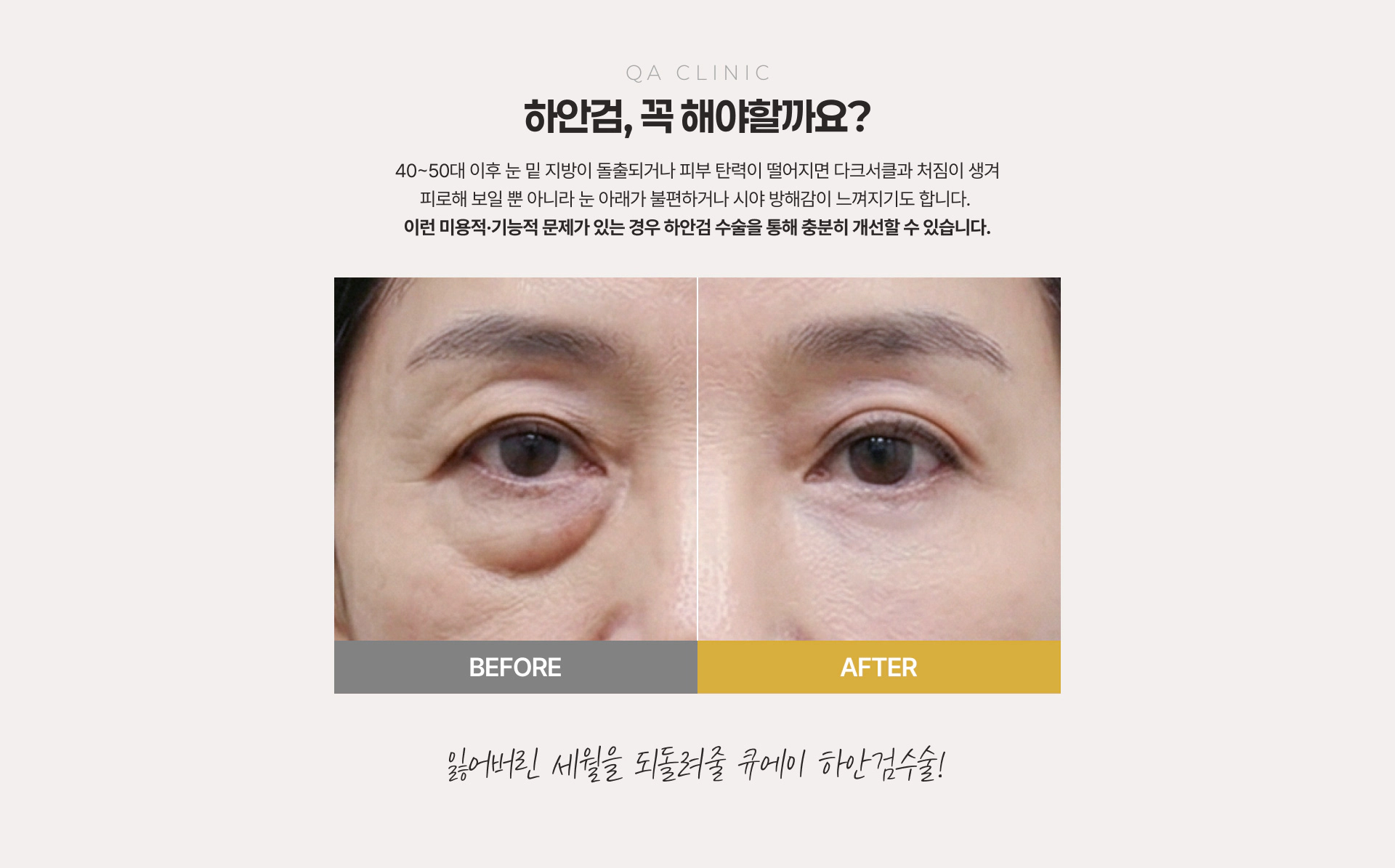 QA CLINIC 하안검, 꼭 해야할까요? 수술 전후 비교
