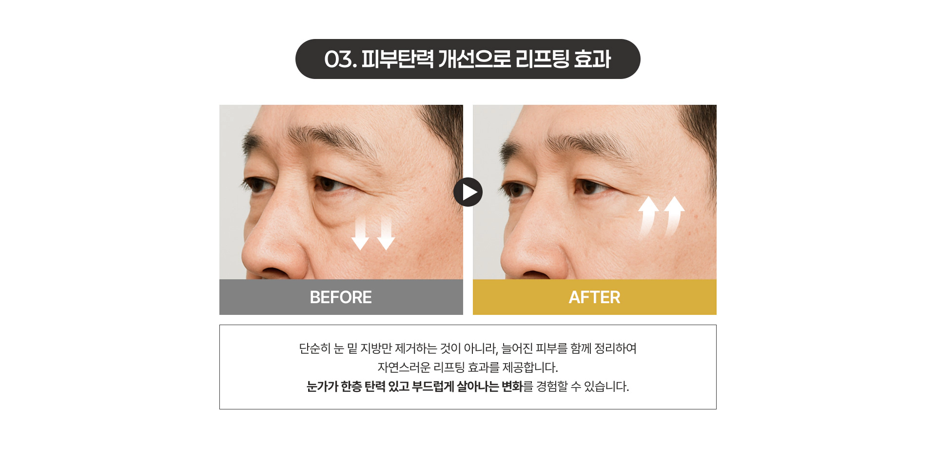 03. 피부탄력 개선으로 리프팅 효과 수술 전후
