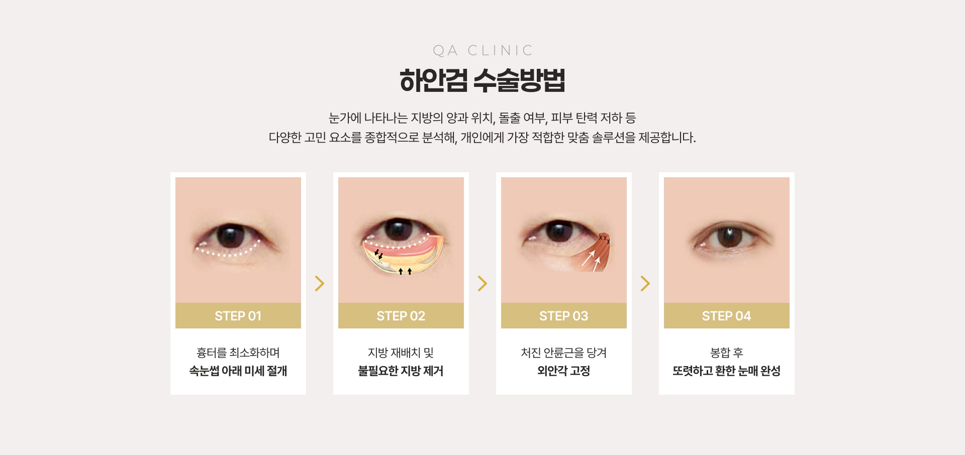 QA CLINIC 하안검 수술방법 STEP 01~04