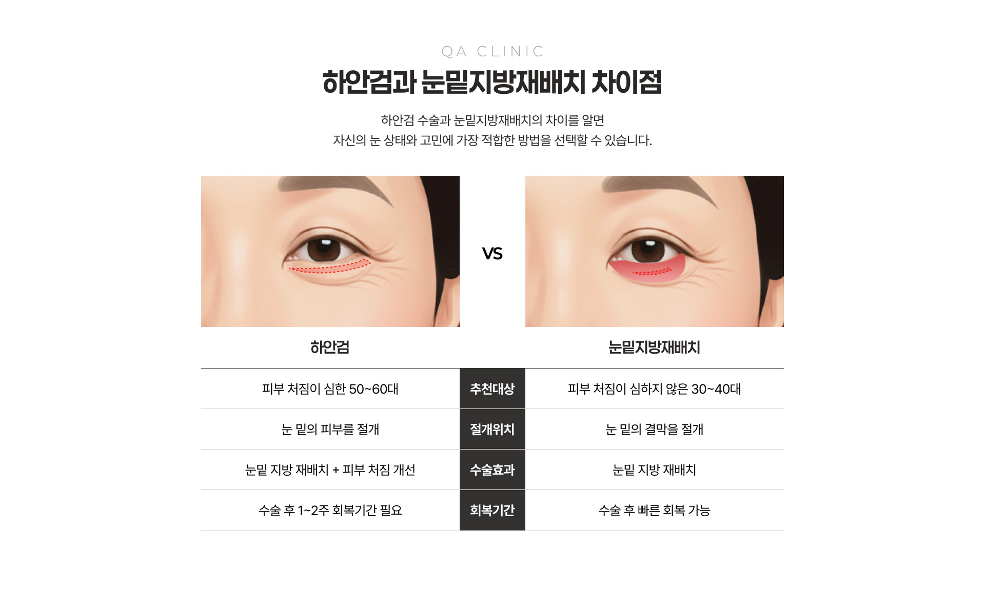 QA CLINIC 하안검과 눈밑지방재배치 차이점 비교