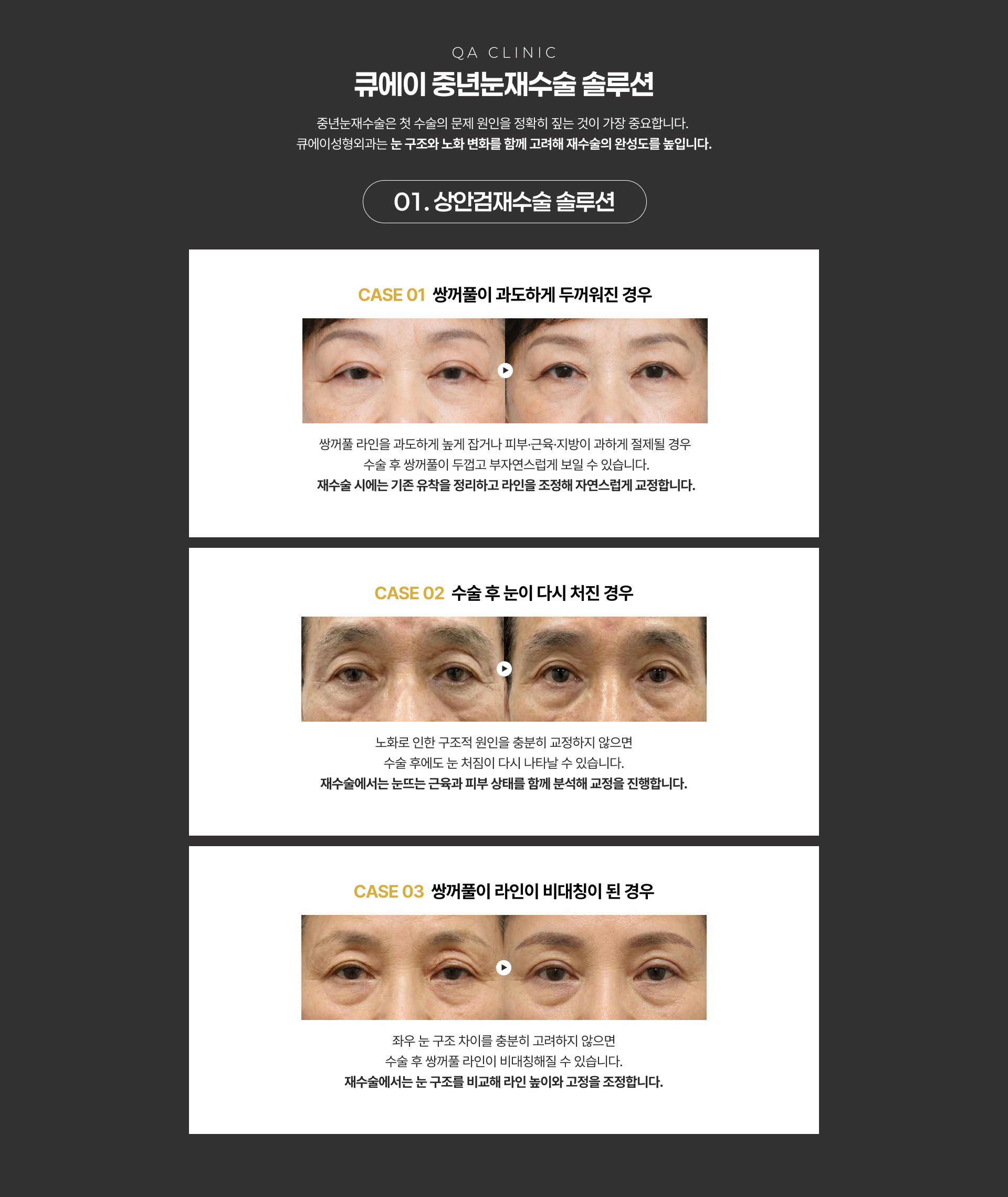 QA CLINIC 큐에이 중년눈재수술 솔루션 01. 상안검재수술 솔루션