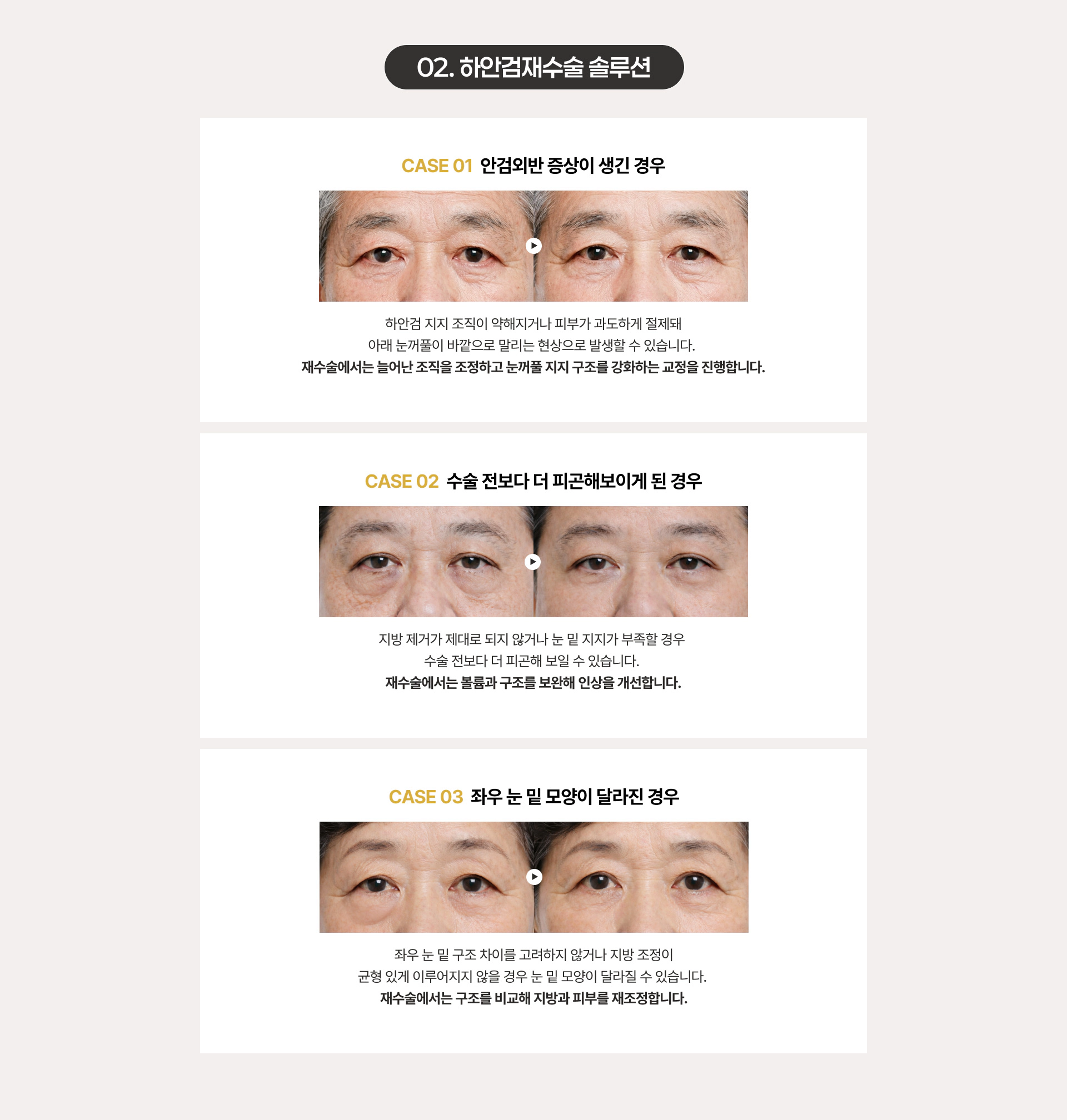 02. 하안검재수술 솔루션
