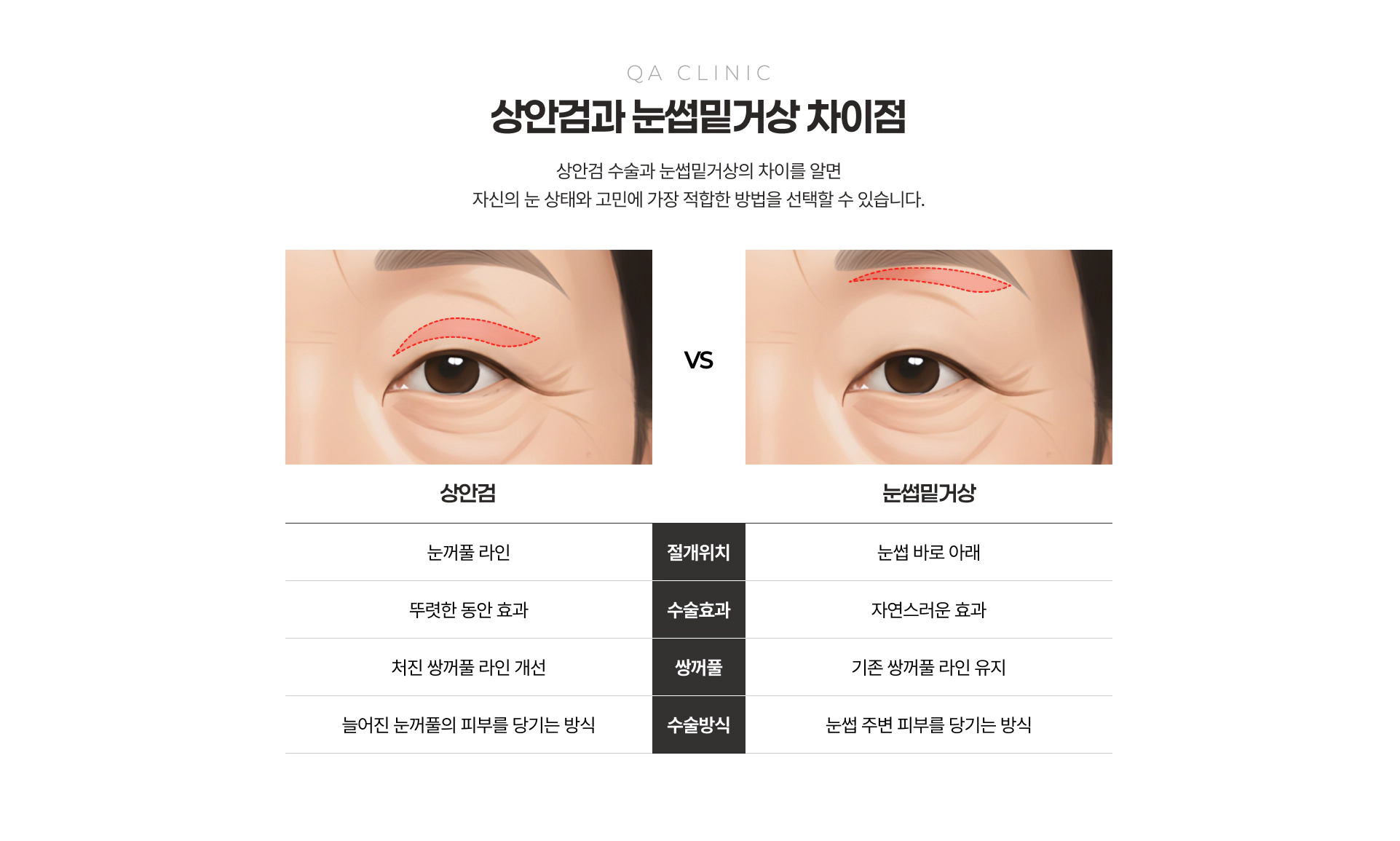 QA CLINIC 상안검과 눈썹밑거상 차이점 비교