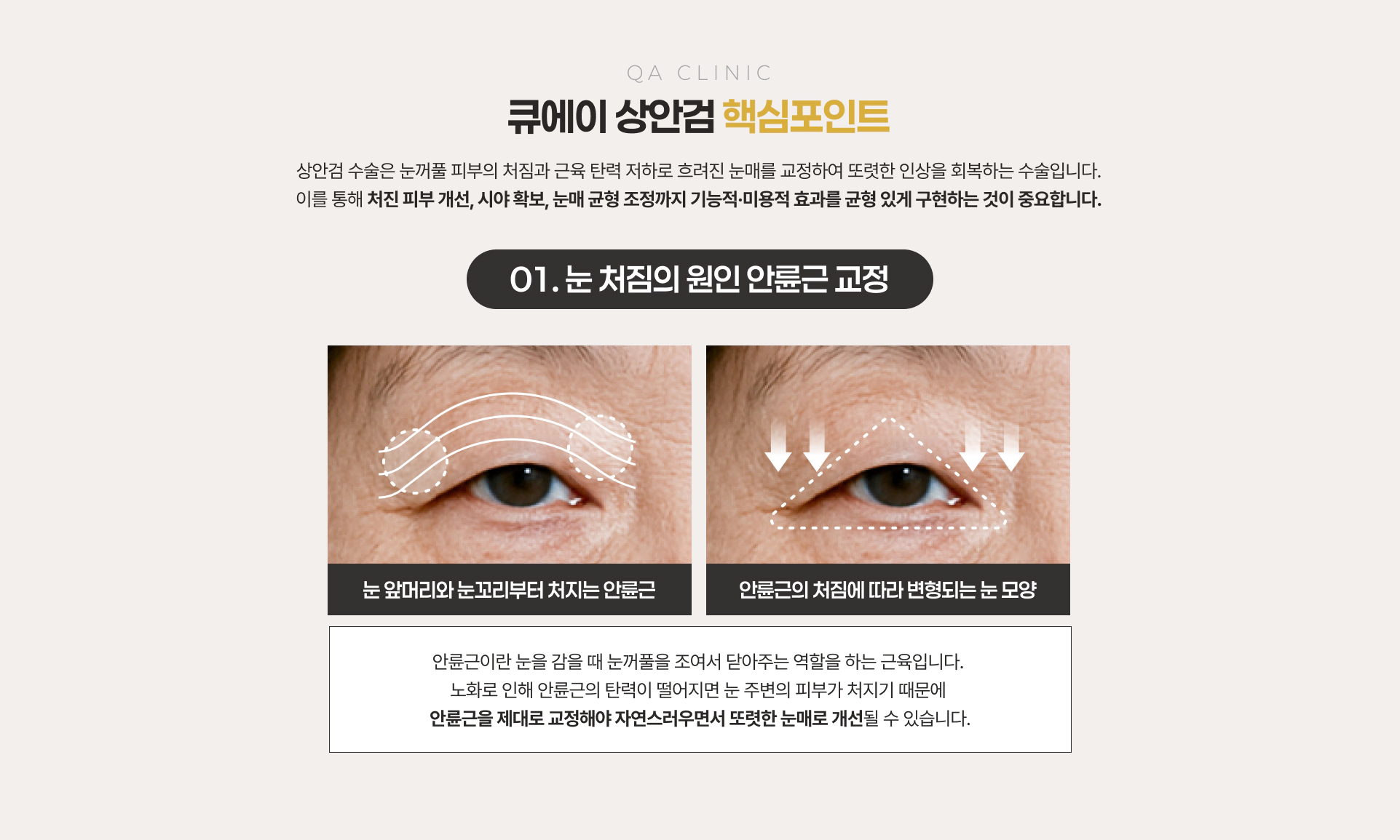 큐에이 상안검 핵심포인트 01 눈 처짐의 원인 안륜근 교정