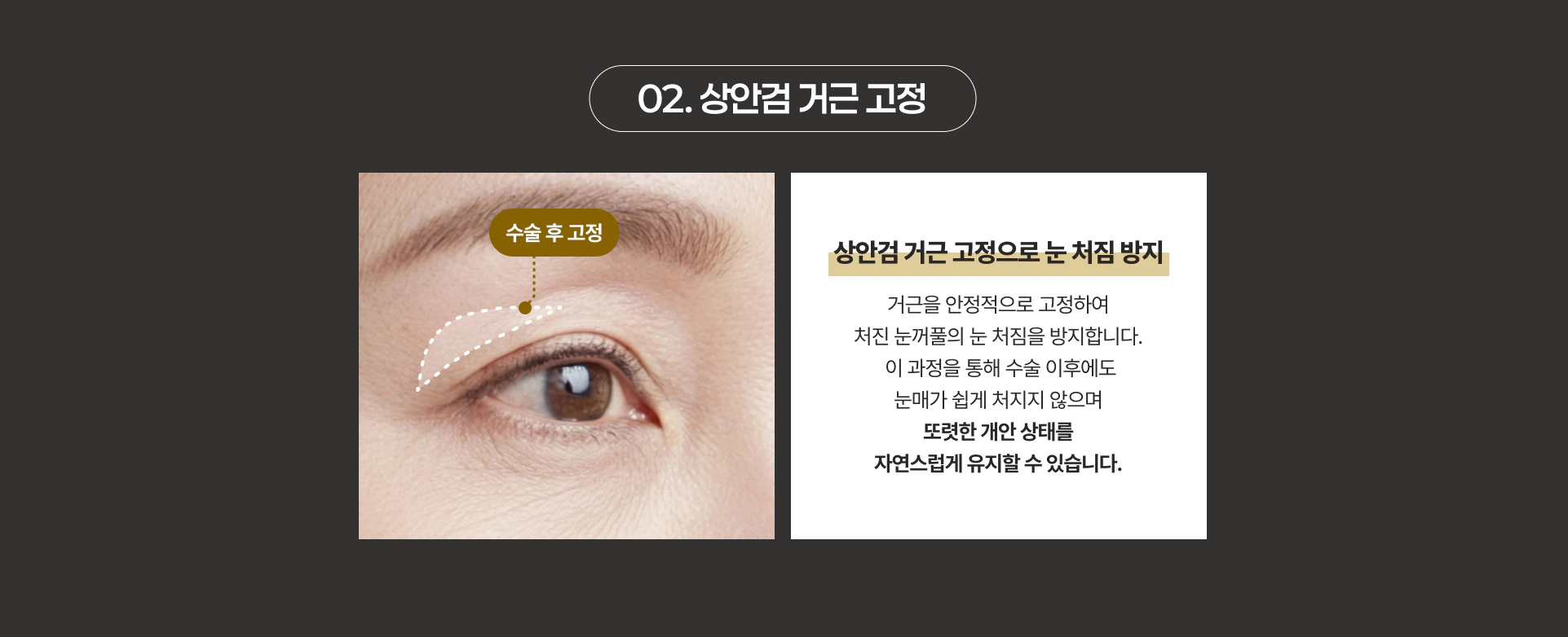 02. 상안검 거근 고정 수술 후 고정