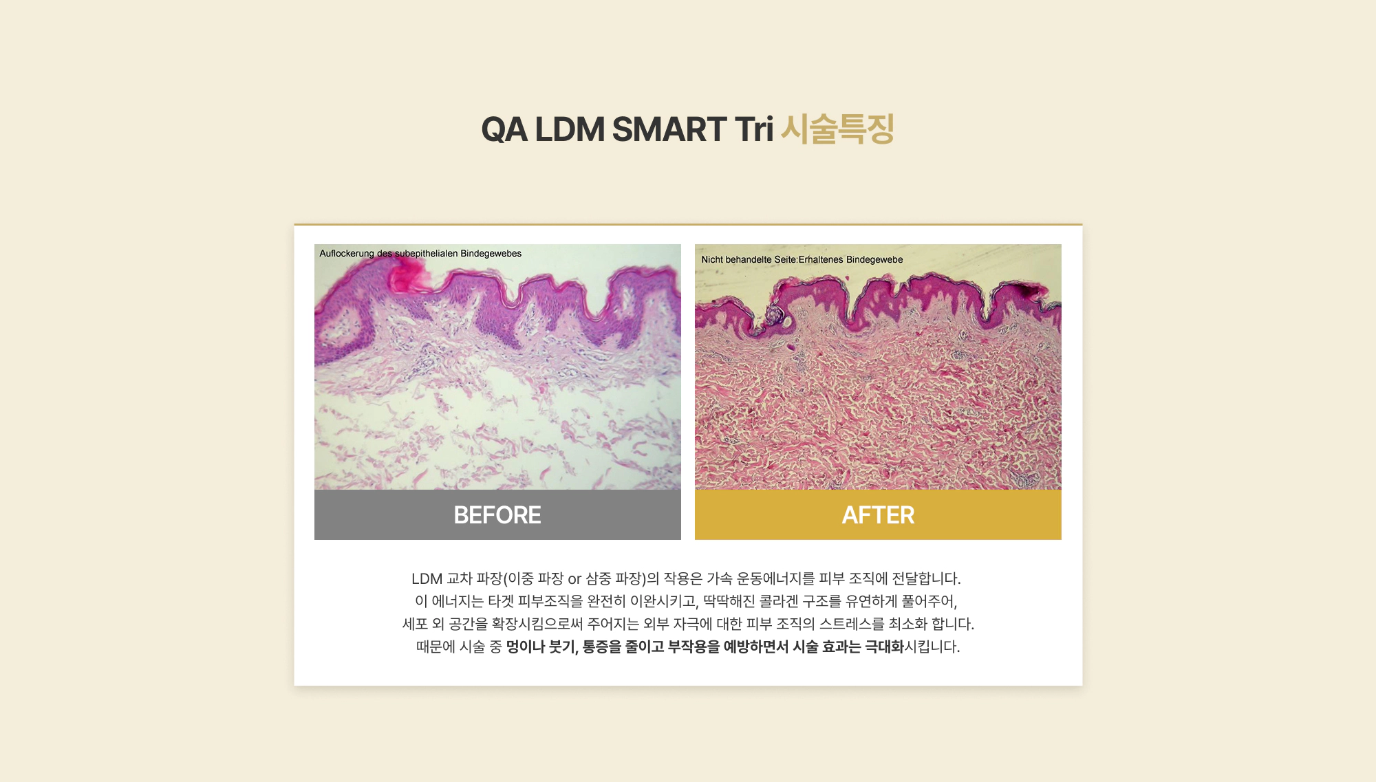 QA LDM SMART Tri 시술특징 BEFORE AFTER