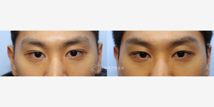 눈재수술1.jpg