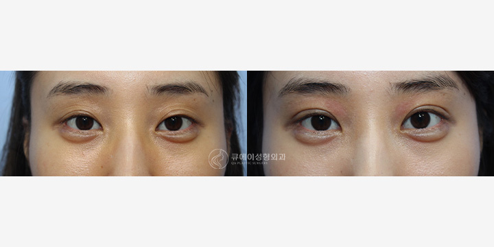 눈재수술2.jpg