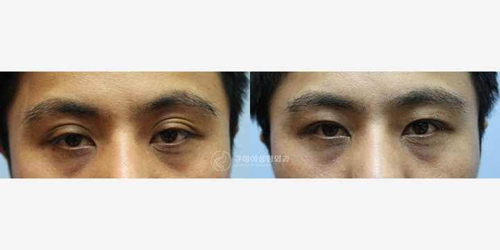 눈재수술4.jpg
