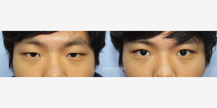 눈매교정비절개1.jpg