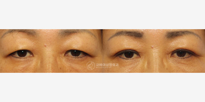 눈썹및거상술1.jpg