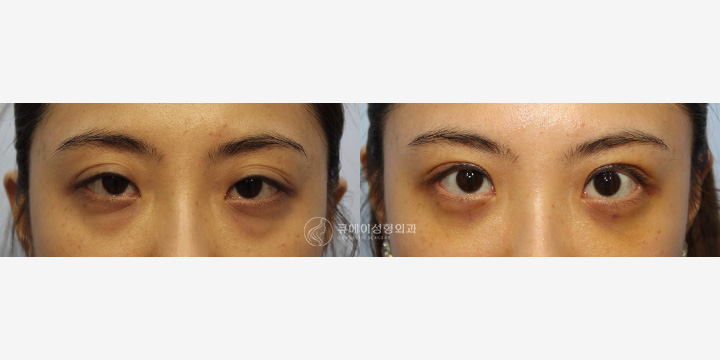 눈매교정절개2.jpg