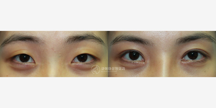 쌍꺼풀매몰2.jpg