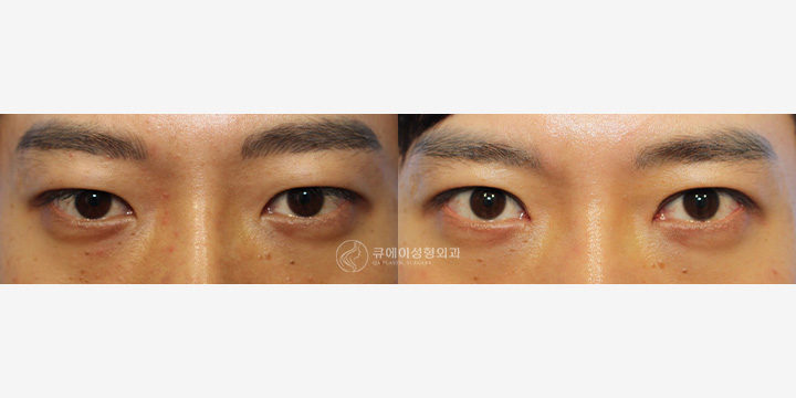 쌍꺼풀매몰3.jpg