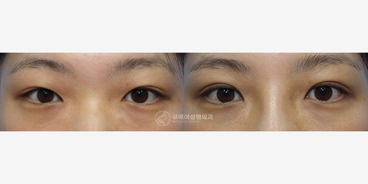쌍꺼풀절개1.jpg