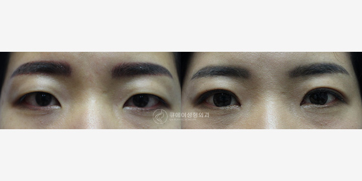 쌍꺼풀절개2.jpg