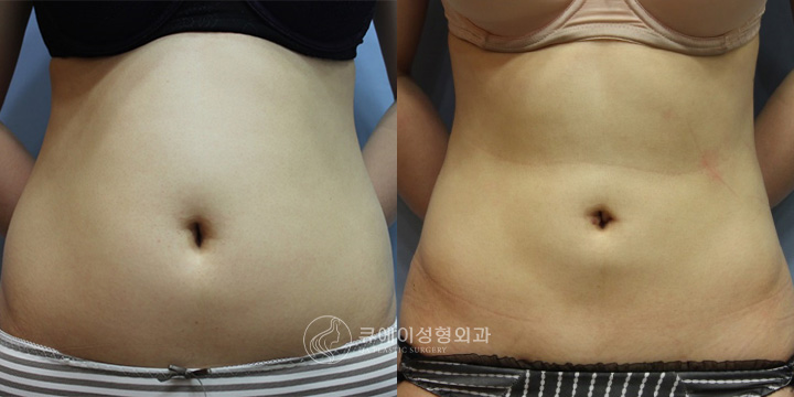 복부지방흡입1-1.jpg