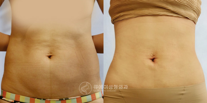 복부지방흡입2.jpg