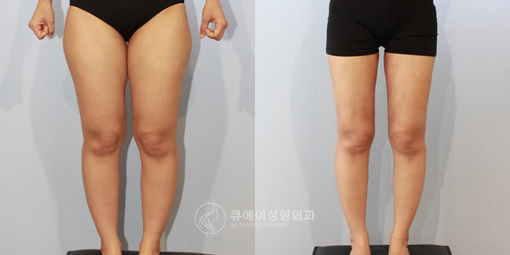허벅지지방흡입1-1.jpg