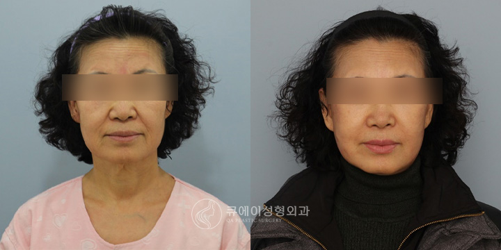 안면거상술2-1.jpg