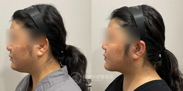 이중턱근육묶기2.jpg