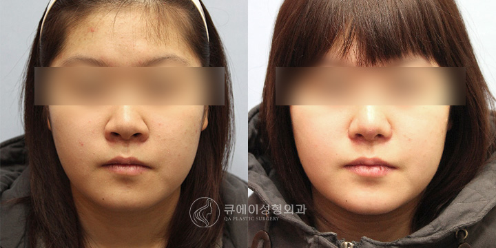 콧볼축소1.jpg