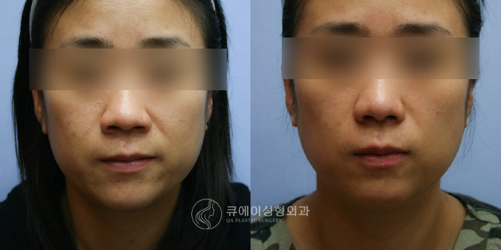 콧볼축소4.jpg
