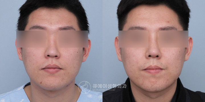 낮은코성형4-1.jpg