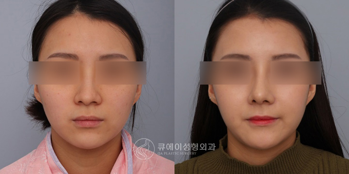 낮은코성형1-1.jpg