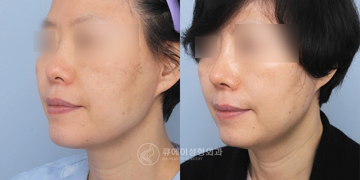 코재수술4.jpg