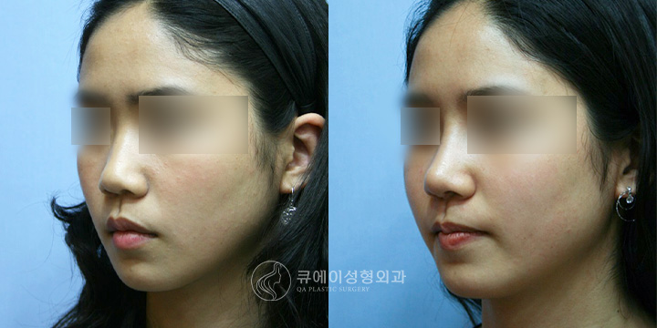 코재수술3.jpg
