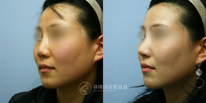 코재수술1.jpg